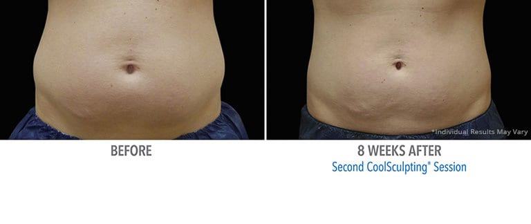 Eps Coolsculpting Abdomen Patient 3