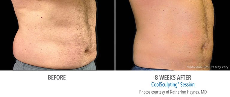 Eps Coolsculpting Abdomen Patient 4