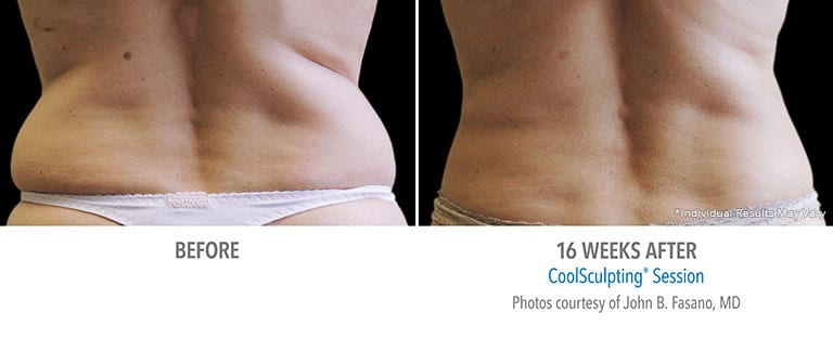 Eps Coolsculpting Back Patient 5