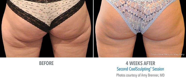 Eps Coolsculpting Butt Patient 1