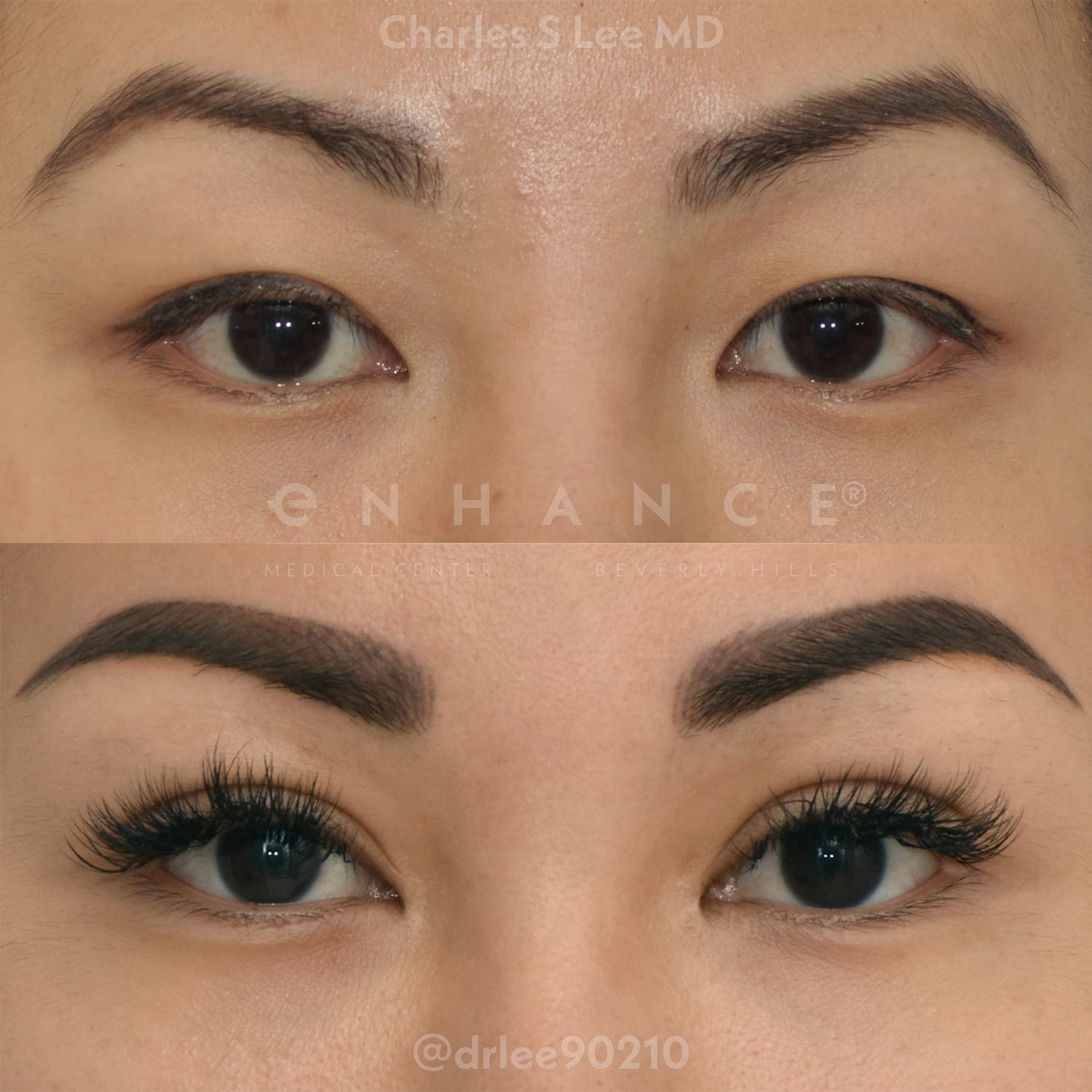 blepharoplasty, eyelid surgery