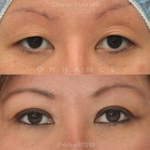 Will Insurance Cover My Eyelid Surgery?