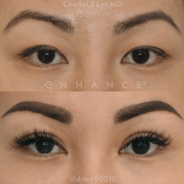 Blepharoplasty Eyelid Surgery Asian