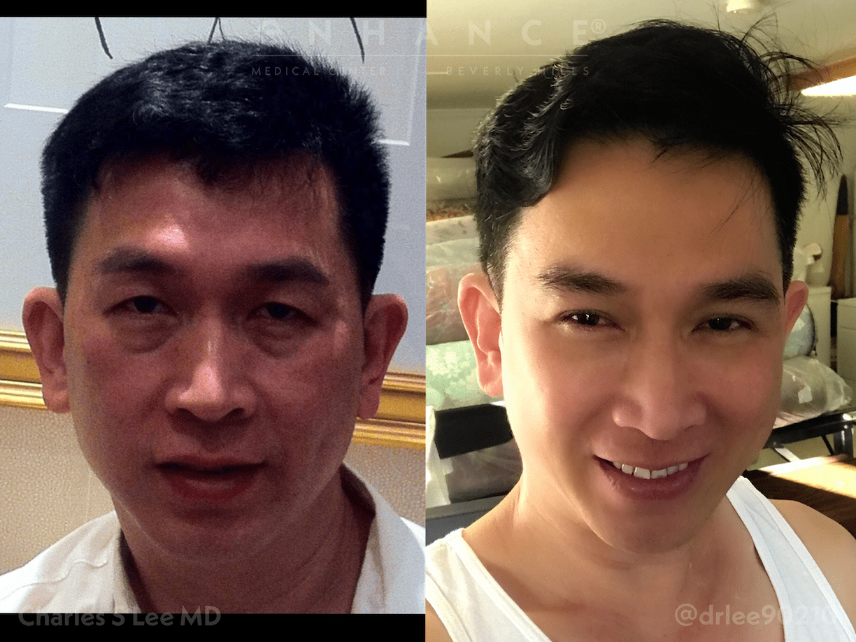 brow lift-eyelid surgery patient