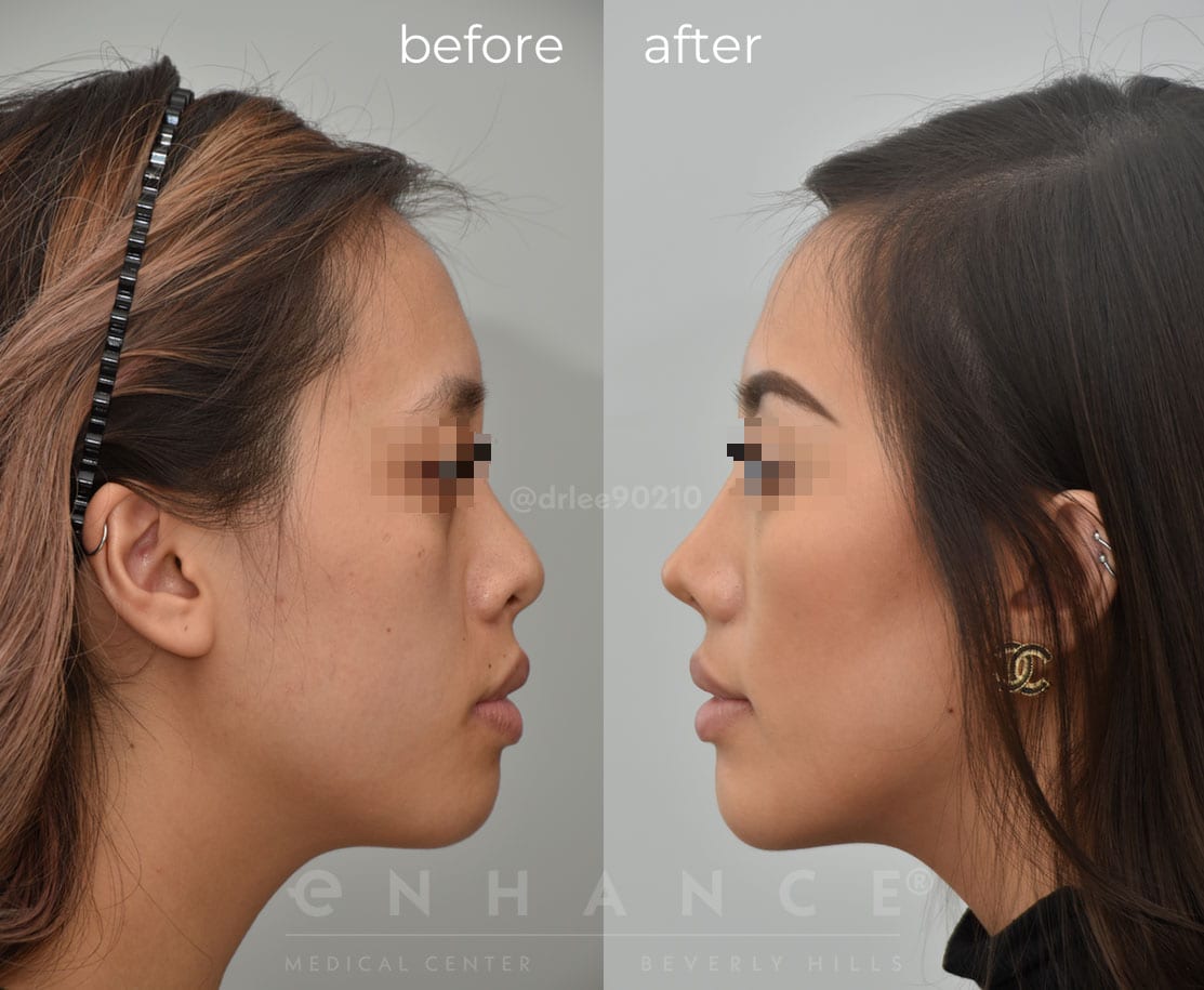 Wide Nose Rhinoplasty Asian