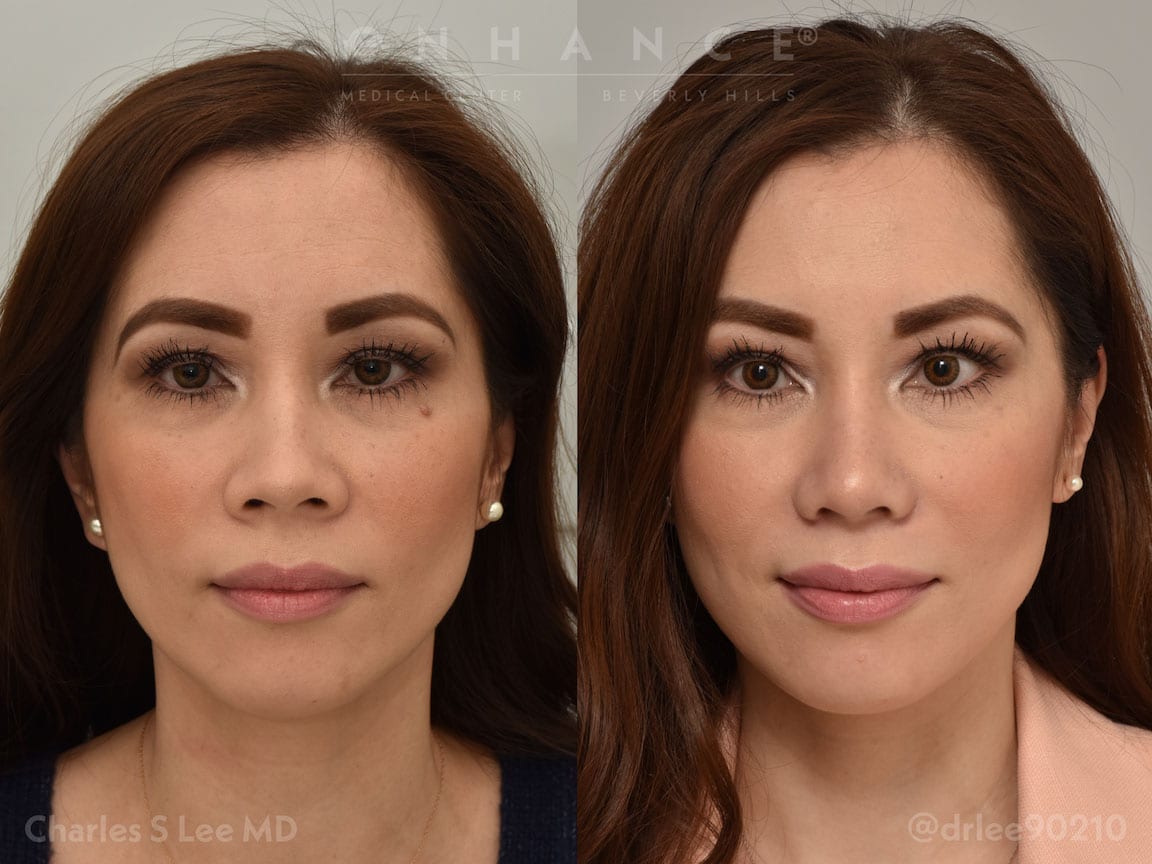 Asian Rhinoplasty Front Patient 2