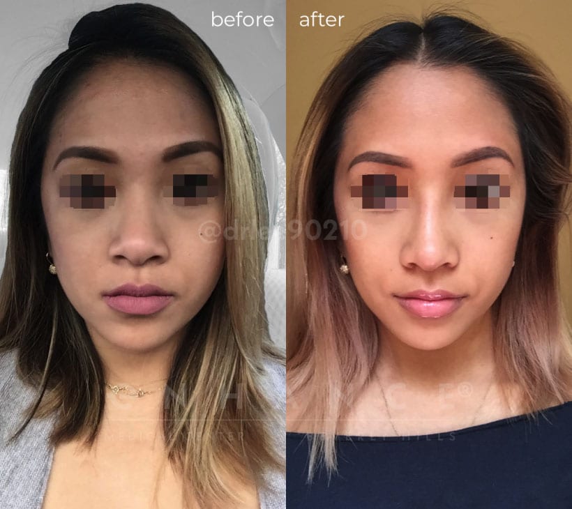 Asian Rhinoplasty Front Patient 3