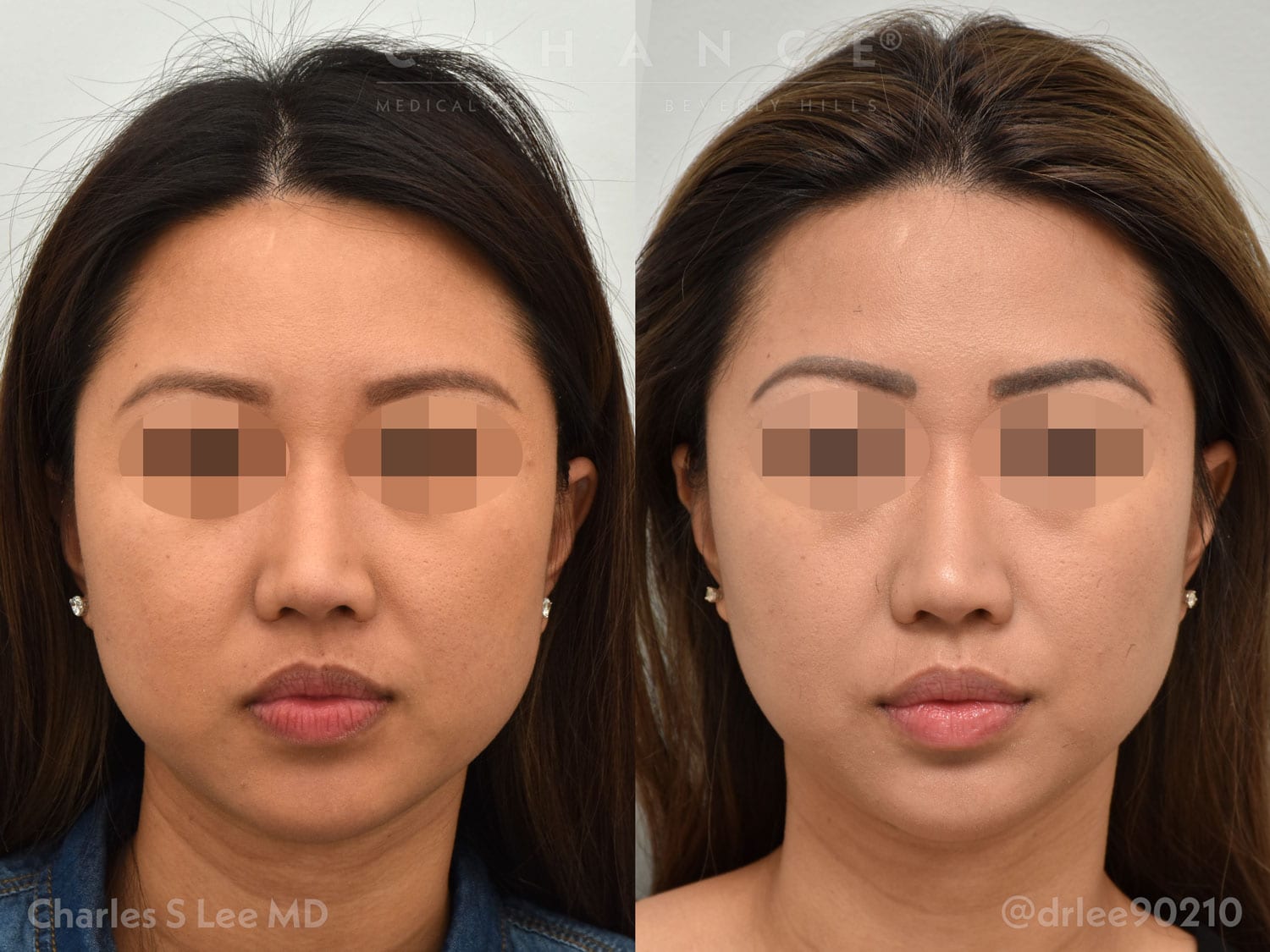 Liposuction Front Patient 1