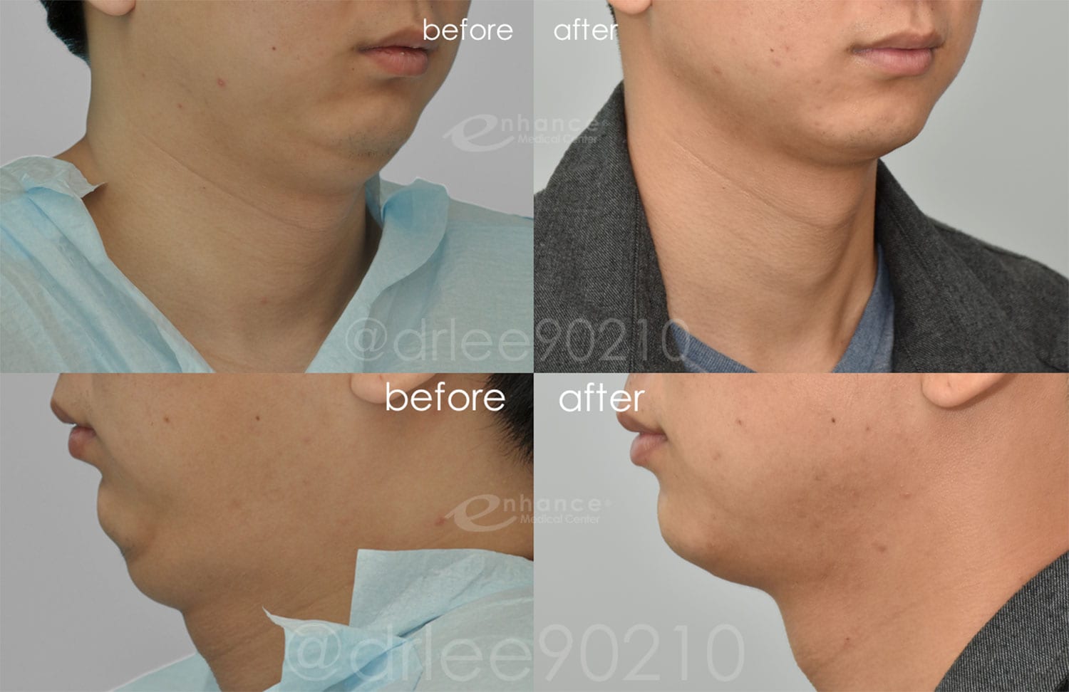 Liposuction Side Patient 2