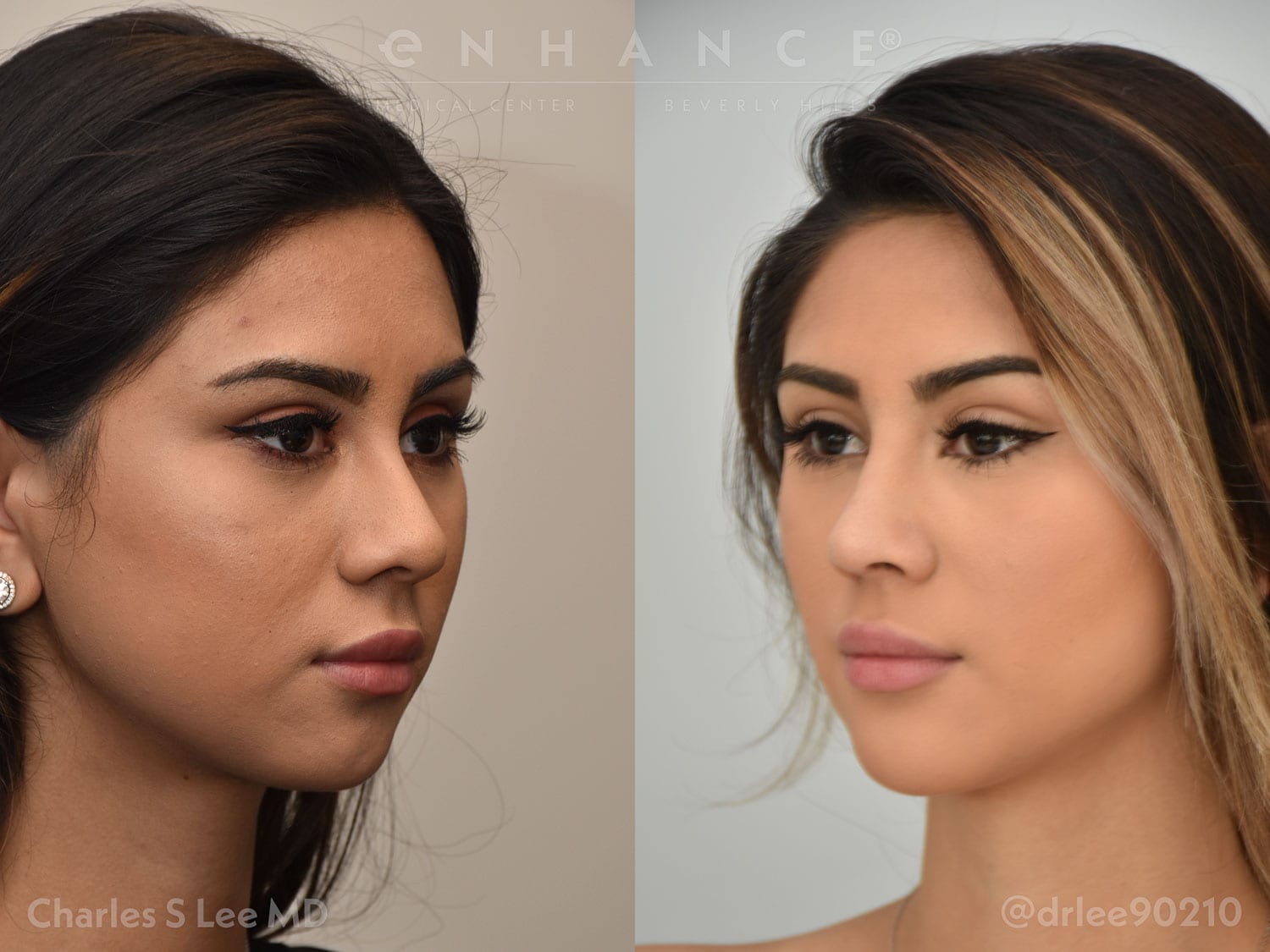 Liposuction Front Patient 5