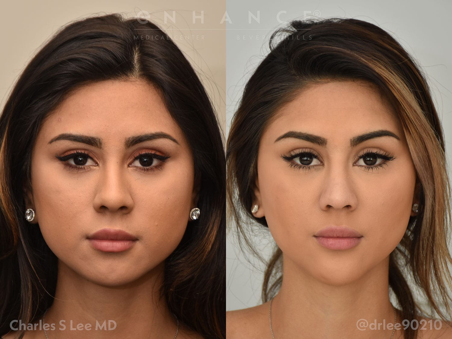 Jaw Augmentation Before & After Gallery