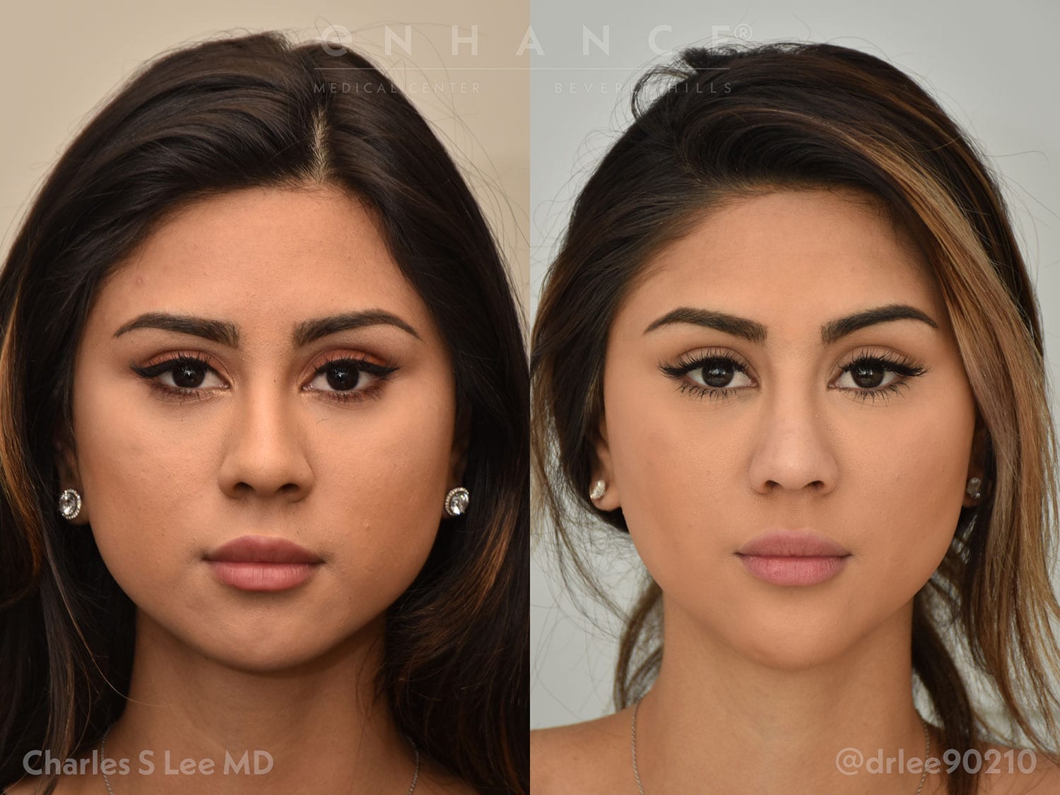 Liposuction Front Patient 3