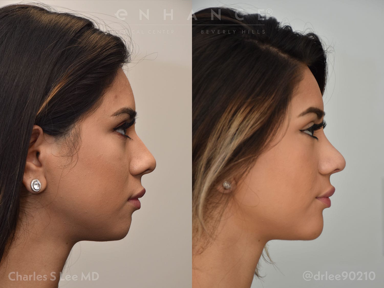 Liposuction Side Patient 4