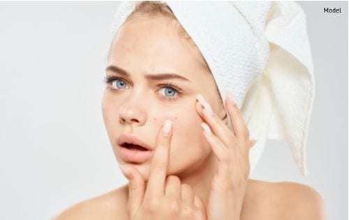 Woman with a white towel on her head squeezes acne on her face.