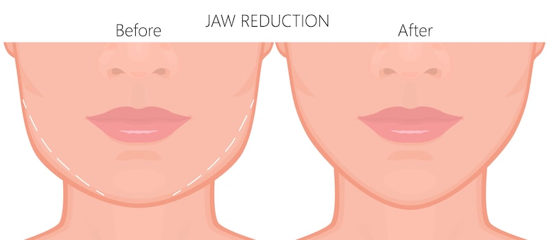 Illustration demonstrating what occurs before and after jawline reduction.