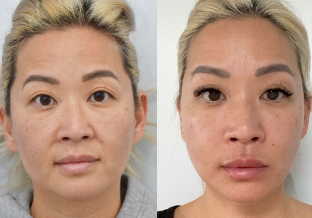 Browlift Before & After Gallery