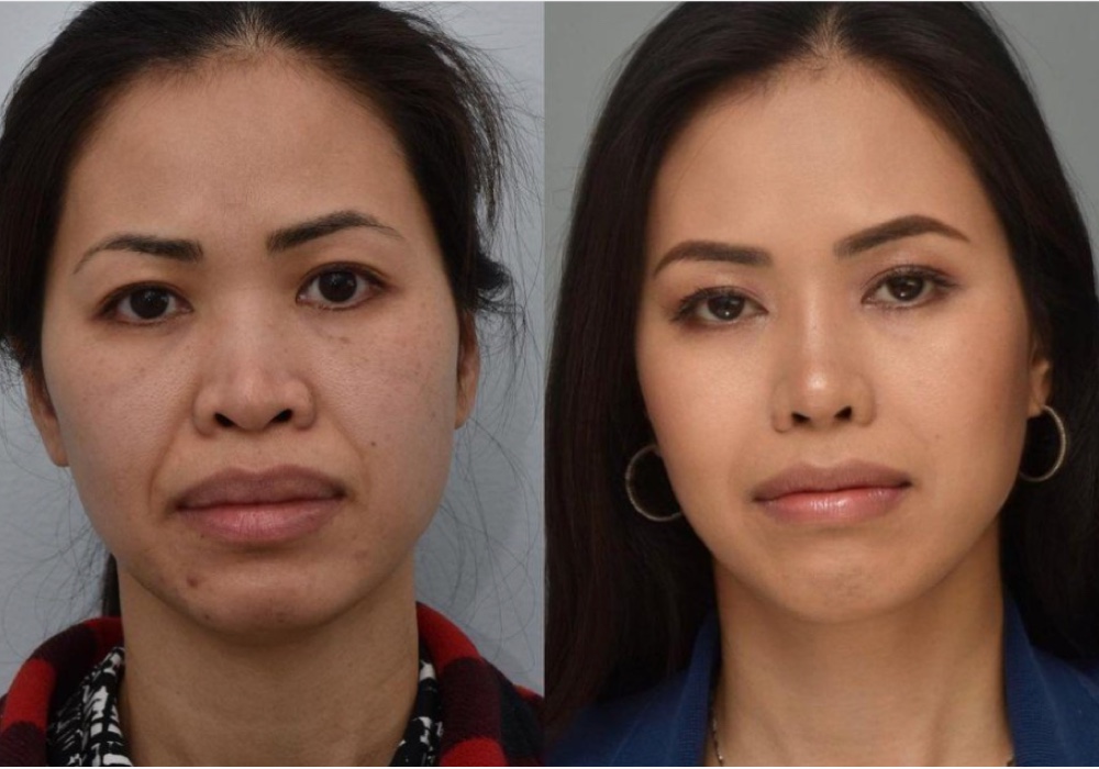 Rhinoplasty Before & After Gallery