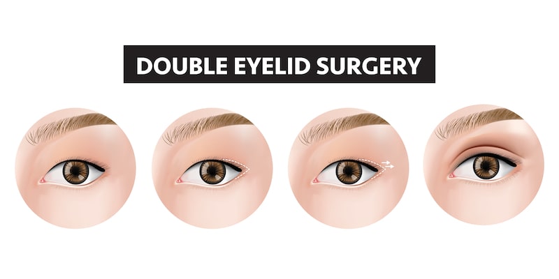 Illustration of double eyelid surgery techniques.