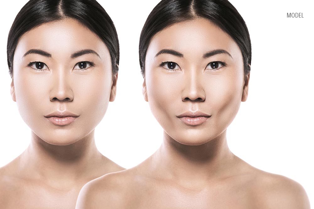 Buccal Fat Removal, Cheekbone Reduction, or V-Line Jaw Reduction — Which Is Right for You?